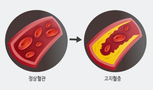 혈관에 지방으로 막혀 있는 모습