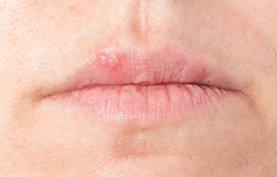 입술수포&amp;#44; 구순포진&amp;#44;헤르페스1