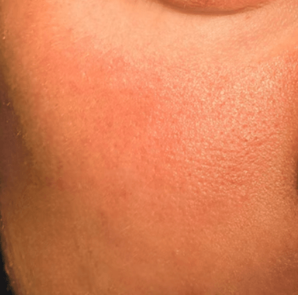 모공 줄이는 방법 - 토너