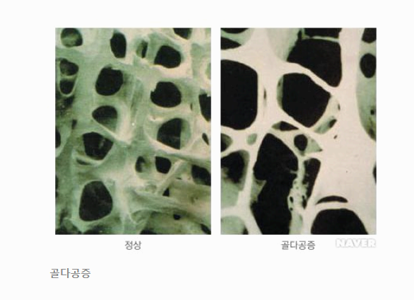 골다공증 주사란? 효과, 부작용, 치료 방법 총정리