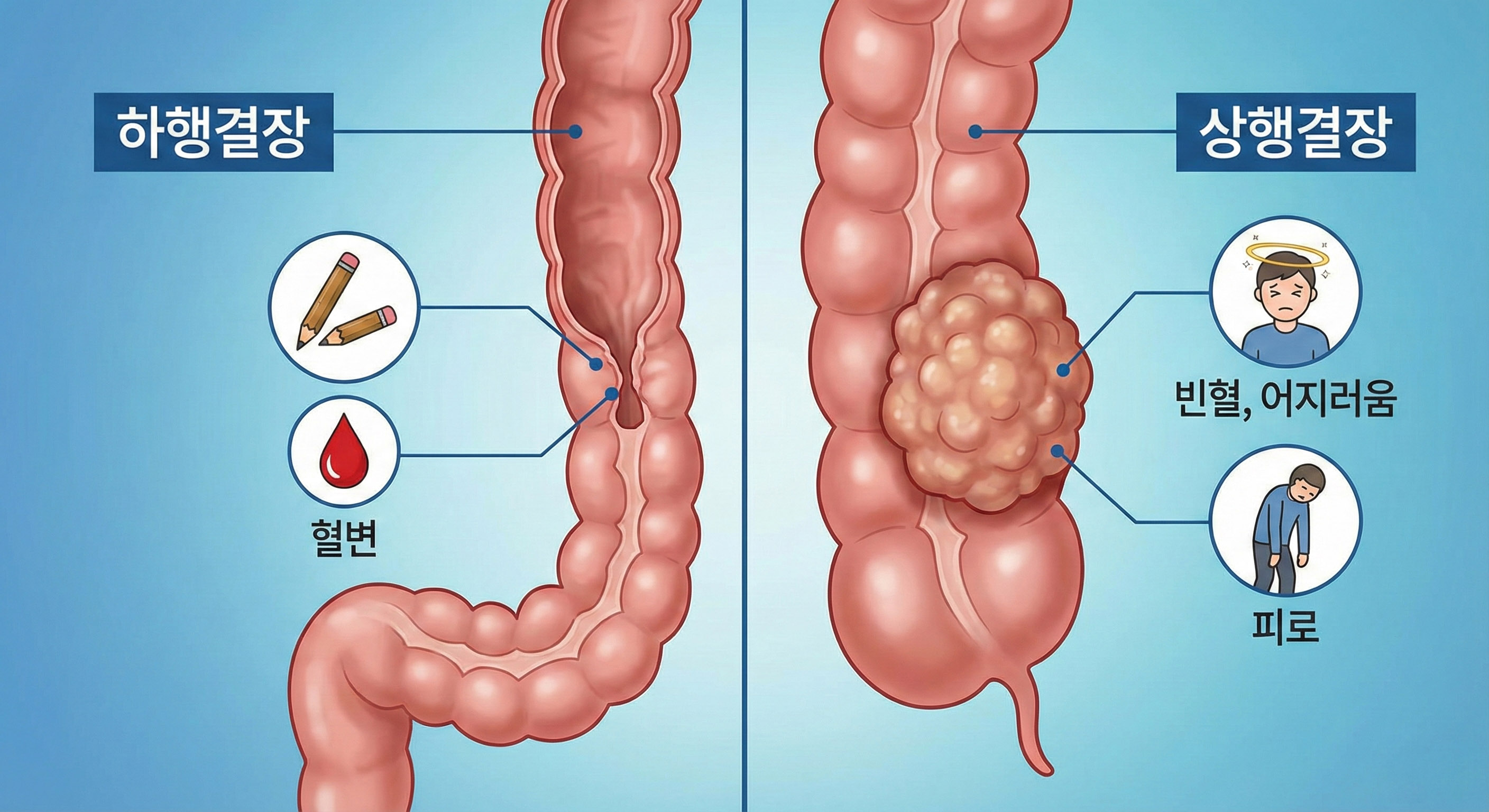 "단순 변비인 줄 알았는데..." 대장암이 보내는 4가지 시그널