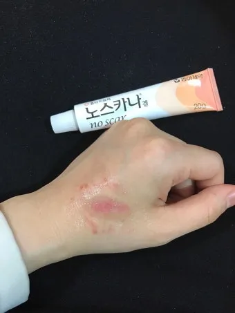 후시딘과 마데카솔 차이와 상처별 추천 사용법까지 정리한 내용_11