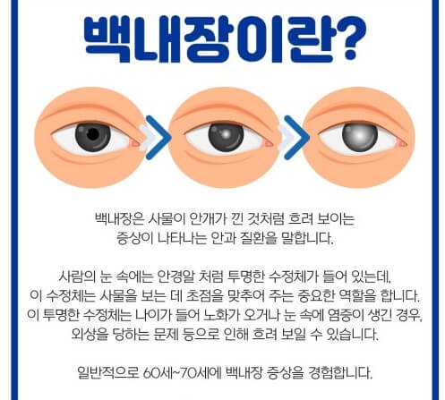 백내장