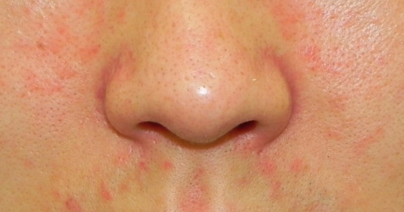 지루성 피부염 얼굴