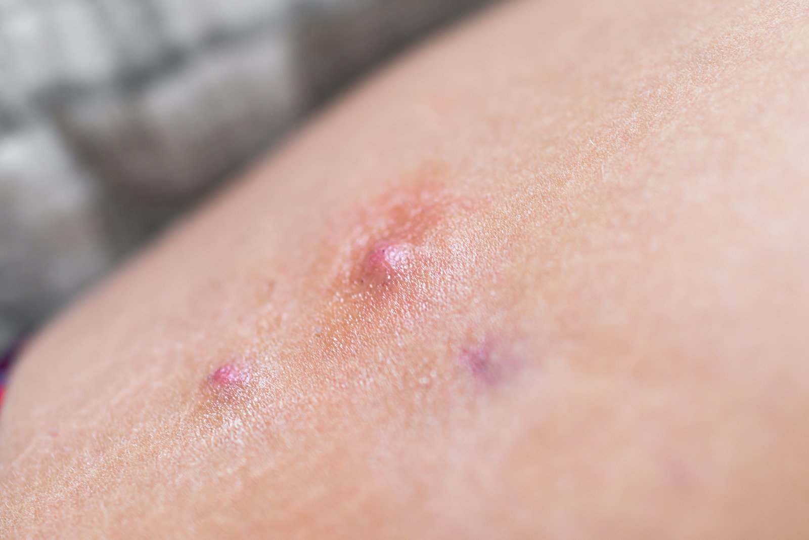 화농성 한선염 (Hidradenitis Suppurativa)