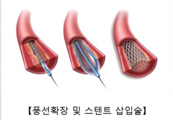 심장 안 좋은 사람, 홍삼 먹어도 될까