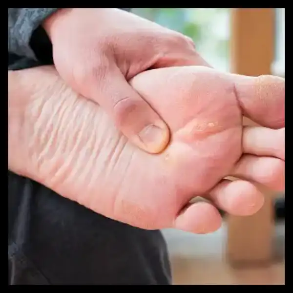 발가락 사이가 찌릿찌릿? 발바닥 신경종!