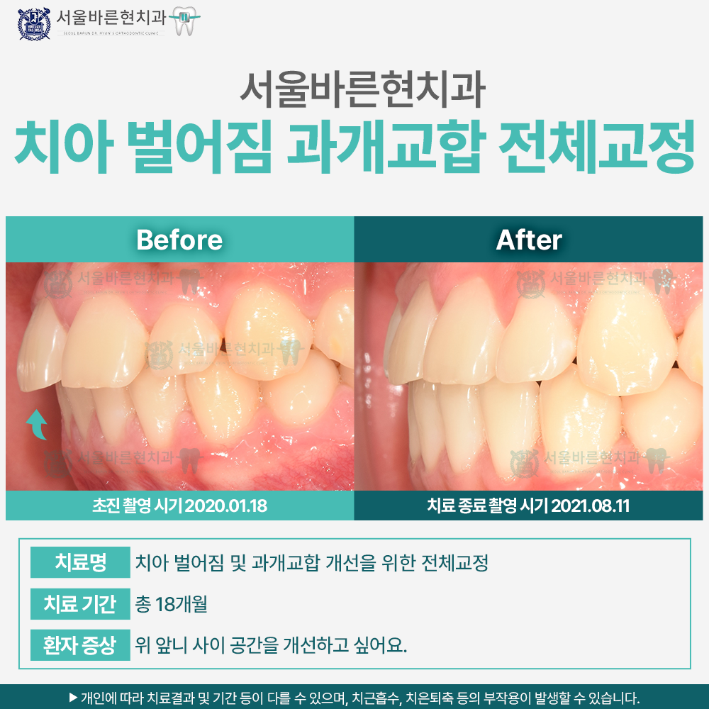 해운대과개교합교정