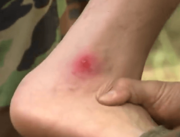 봉와직염의 치료