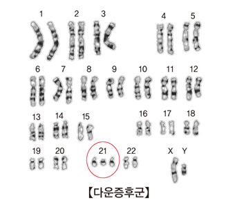 다운증후군 증상·원인·치료