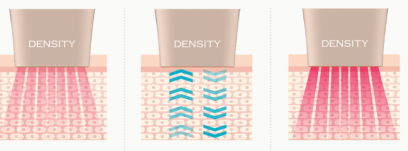 덴서티 고주파&amp;#44;효과부터 가격까지 완벽 정리!