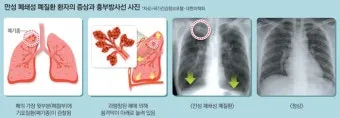 폐질환의 종류 7가지와 예방법 건강관리 필수_17