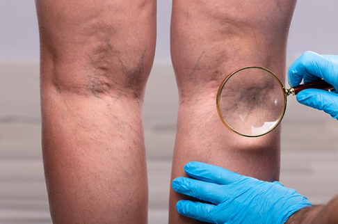 하지정맥류 원인 완전분석 (혈관, 정맥, 생활습관)