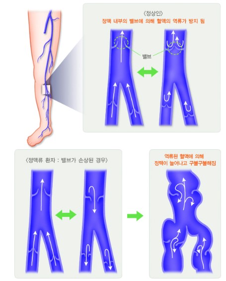 하지정맥류
