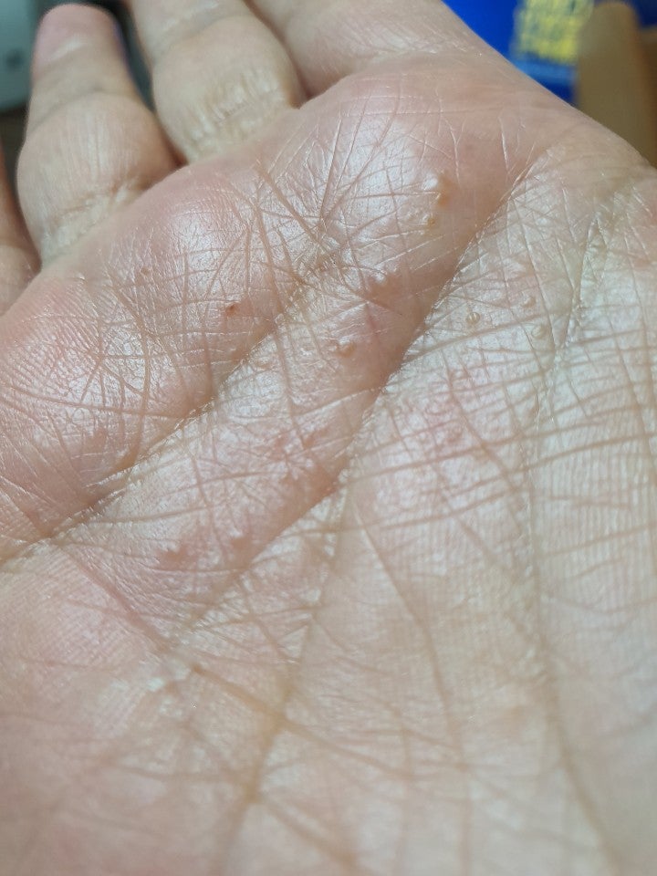 한포진, 손 발에 수포, 가려움증 원인과 치료법, 손발수포전염성