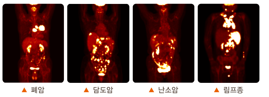 PET CT 검사