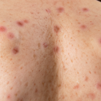 4. 수족구: 빨리 낫는 방법