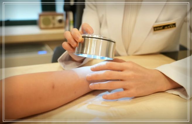 건선 초기 증상