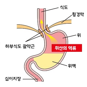 역류성 식도염의 원인-위산의 역류