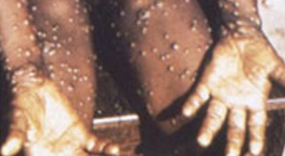 원숭이두창 이미지