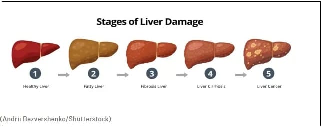 간의 불사조와 같은 자기 치유 능력 그리고 향상시키는 법 The Liver's Phoenix-Like Powers of Self-Healing and How You Can Help It