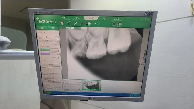 아이 유치 충치치료