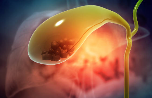 담석증 치료 및 수술 방법 (+ 담석증 원인 증상 수술 후유증)