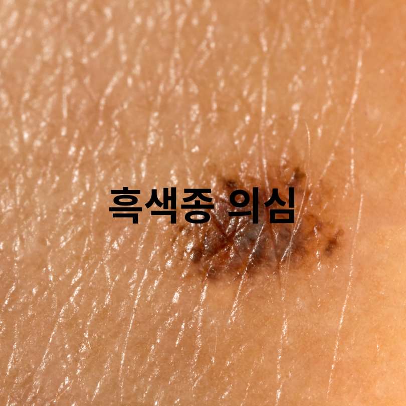 손톱에 검은 줄 증상,원인,치료법