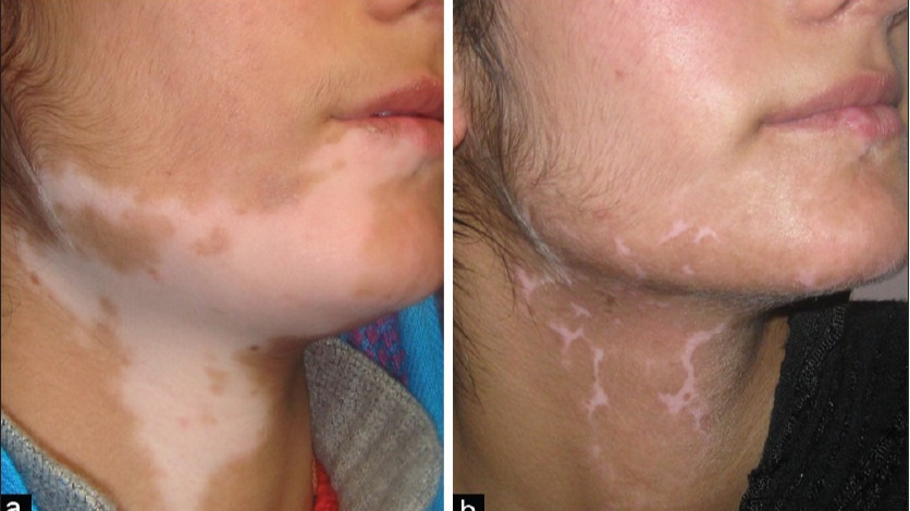 백반증 완벽 가이드