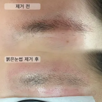 눈썹 문신 제거 방법 꿀팁_17