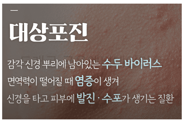 대상포진 증상 설명