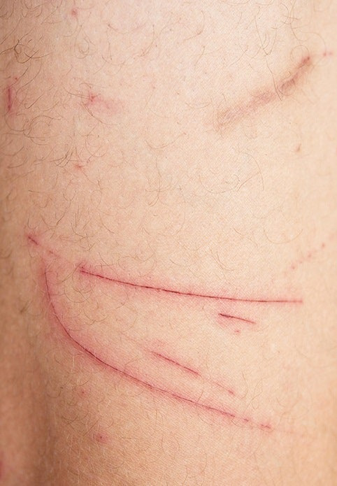 당뇨병 초기증상