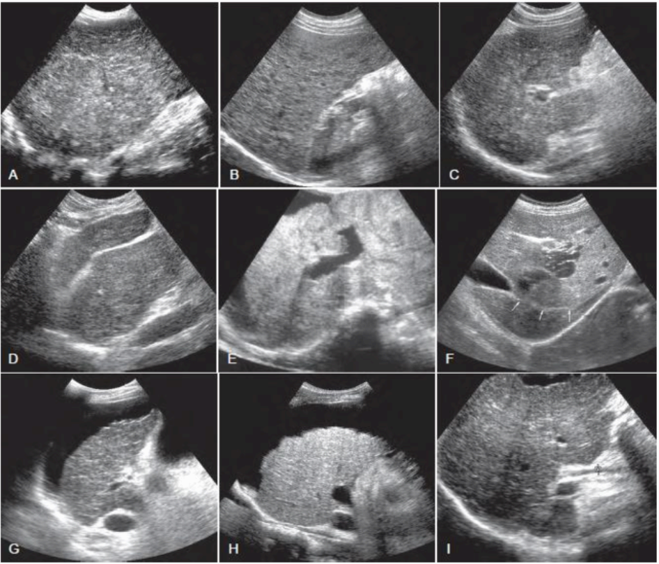 간경화증 (Liver cirrhosis)