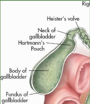 미리찌 증후군 (Mirizzi&amp;#39;s syndrom)