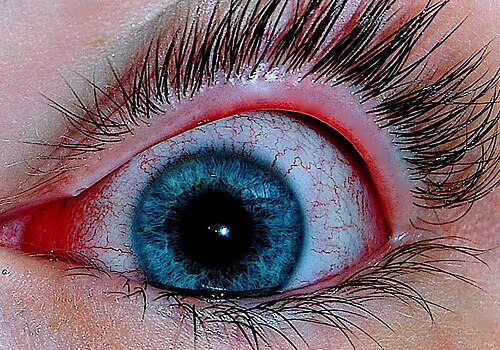 결막염 원인&middot;증상&middot;치료