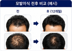 원형탈모이미지