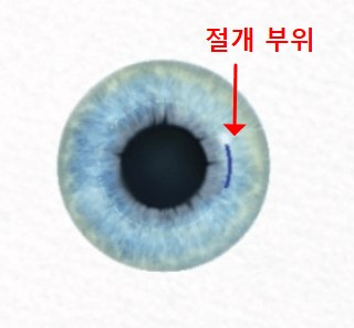 스마일 라식 후기 부작용 병원 (7년 후기)