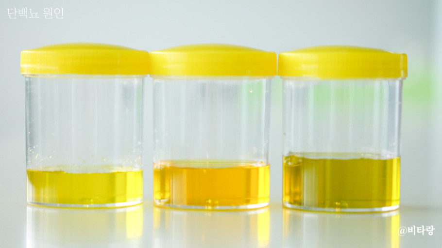 오줌 색깔과 병