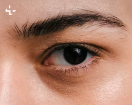 다래끼, 정말 전염될까?