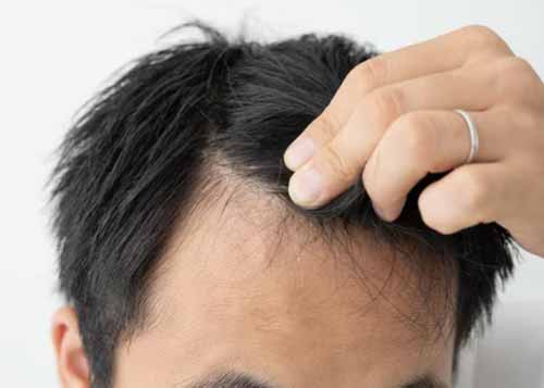 개인 맞춤형 탈모 치료법, 유전자&middot;두피 진단으로 설계한다