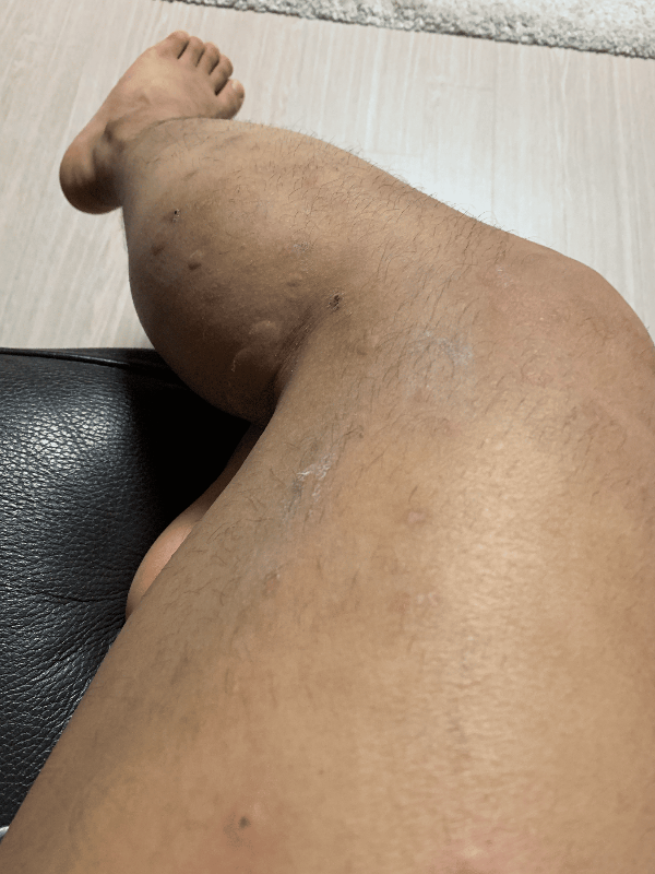 가려운 두드러기 증상