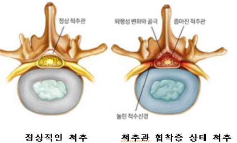 정상적인 척추 및 척추관 협착증 상태 척추