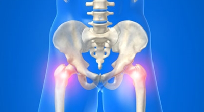 고관절 이미지