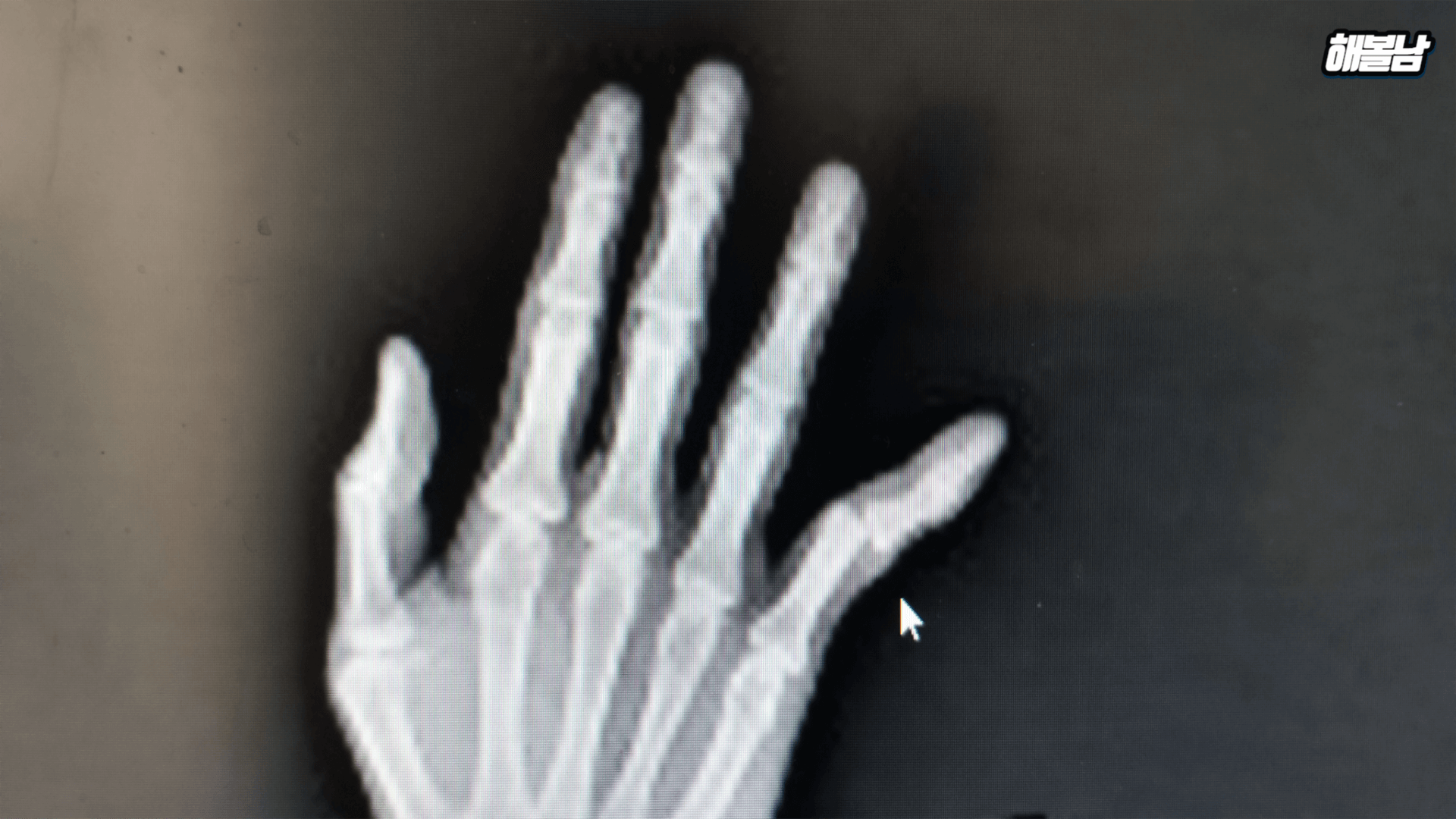 손락락인대파열-사진촬영