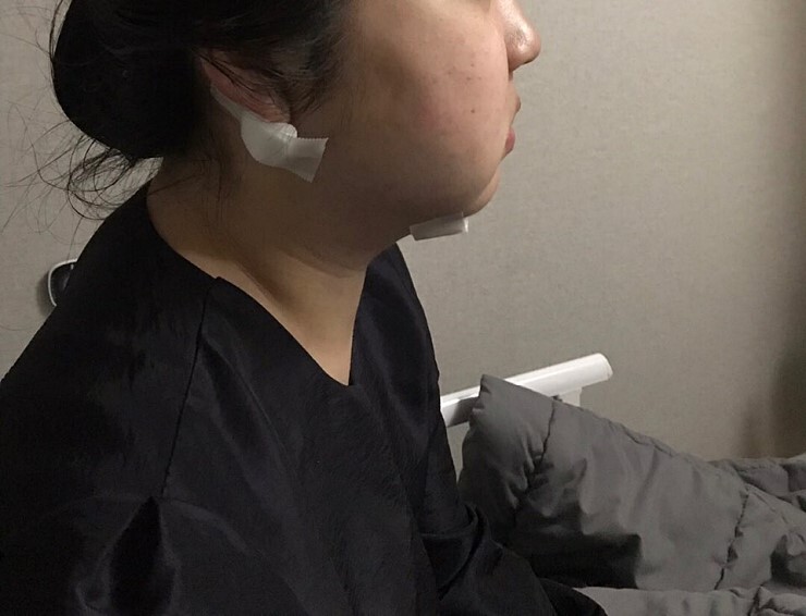 턱살지방흡입 후기