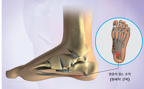 족저근막염