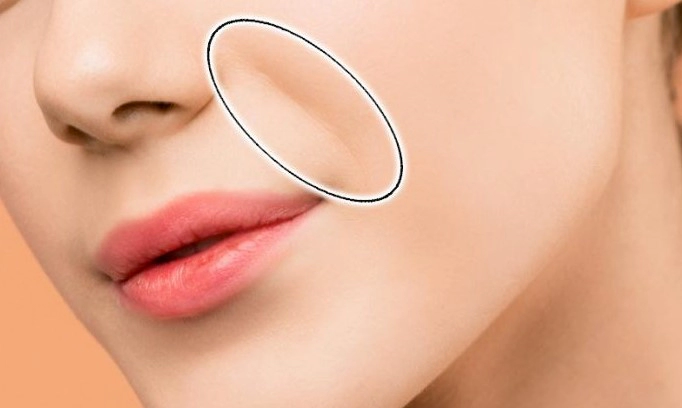 팔자주름 원인 없애는 방법 및 팔자주름 수술비용 종류 