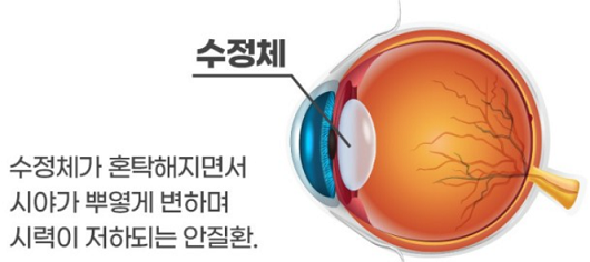 백내장이란?