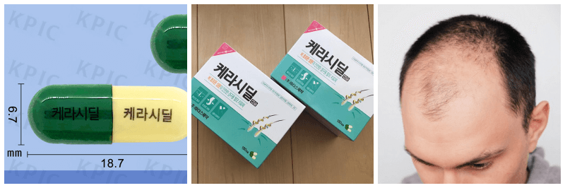 케라시딜 캡슐, 탈모 사진