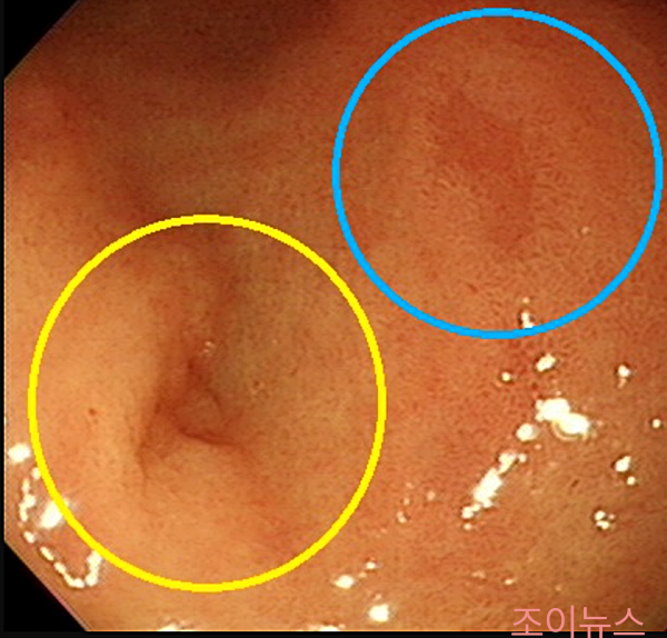 미란성위염1_출처:EndoToday